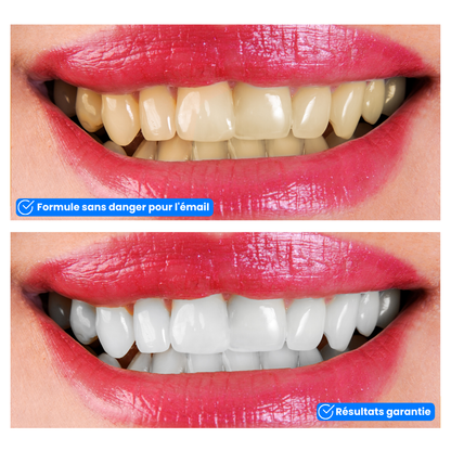 Whitening Strips - Sou'rire™